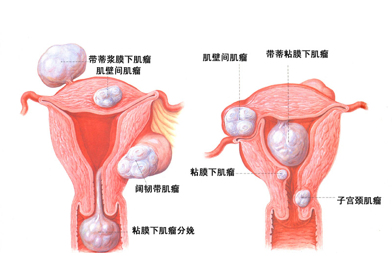 子宫肌瘤