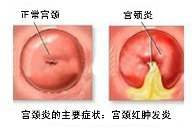 宫颈炎