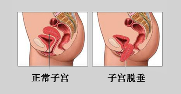 子宫脱垂