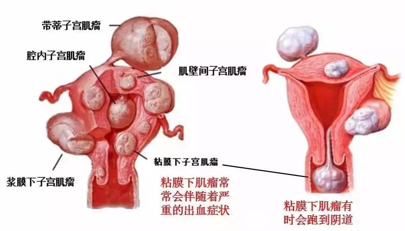 粘膜下肌瘤