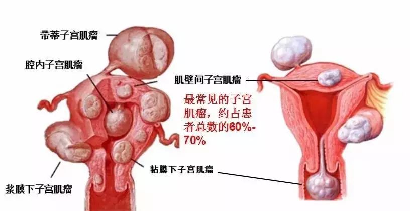 肌壁间肌瘤